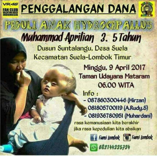 Bocah Hydrocephalus