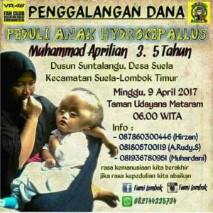 Bocah Hydrocephalus Bocah Hydrocephalus